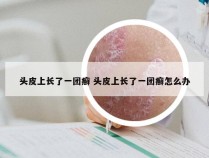头皮上长了一团癣 头皮上长了一团癣怎么办