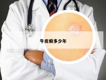 牛皮癣多少年