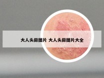 大人头藓图片 大人头藓图片大全