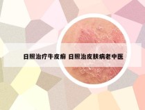 日照治疗牛皮癣 日照治皮肤病老中医