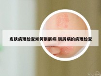 皮肤病理检查如何银屑病 银屑病的病理检查