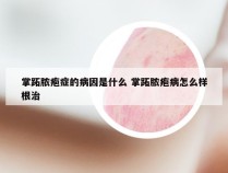 掌跖脓疱症的病因是什么 掌跖脓疱病怎么样根治