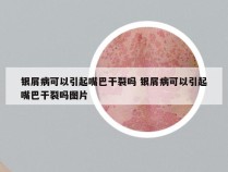 银屑病可以引起嘴巴干裂吗 银屑病可以引起嘴巴干裂吗图片
