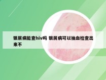银屑病能查hiv吗 银屑病可以抽血检查出来不