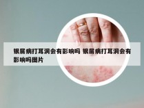 银屑病打耳洞会有影响吗 银屑病打耳洞会有影响吗图片