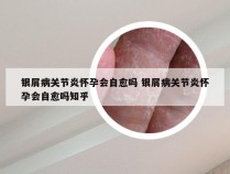 银屑病关节炎怀孕会自愈吗 银屑病关节炎怀孕会自愈吗知乎
