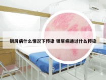 银屑病什么情况下传染 银屑病通过什么传染