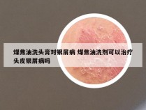 煤焦油洗头膏对银屑病 煤焦油洗剂可以治疗头皮银屑病吗