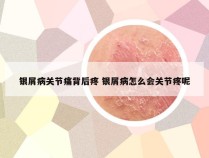 银屑病关节痛背后疼 银屑病怎么会关节疼呢