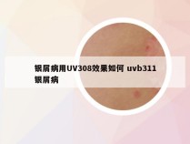 银屑病用UV308效果如何 uvb311银屑病