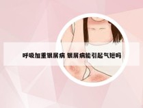 呼吸加重银屑病 银屑病能引起气短吗