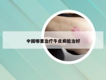 中国哪里治疗牛皮癣能治好