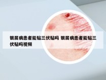 银屑病患者能贴三伏贴吗 银屑病患者能贴三伏贴吗视频