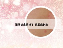 银屑病皮揭掉了 银屑病剥皮
