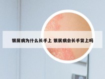 银屑病为什么长手上 银屑病会长手背上吗