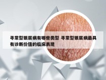 寻常型银屑病有哪些类型 寻常型银屑病最具有诊断价值的临床表现