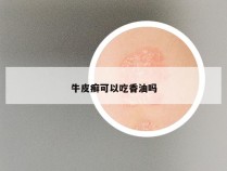 牛皮癣可以吃香油吗