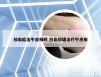 放血能治牛皮癣吗 放血拔罐治疗牛皮癣
