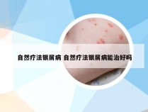 自然疗法银屑病 自然疗法银屑病能治好吗