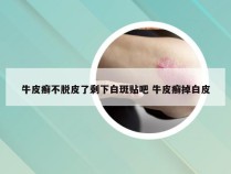 牛皮癣不脱皮了剩下白斑贴吧 牛皮癣掉白皮