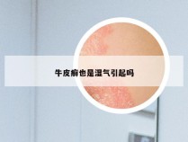 牛皮癣也是湿气引起吗