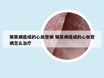 银屑病造成的心血管病 银屑病造成的心血管病怎么治疗