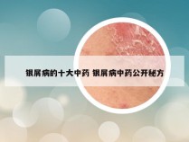 银屑病的十大中药 银屑病中药公开秘方