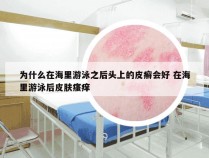 为什么在海里游泳之后头上的皮癣会好 在海里游泳后皮肤瘙痒