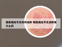 银屑病关节炎如何消肿 银屑病关节炎消肿用什么药