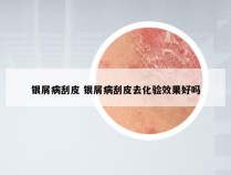 银屑病刮皮 银屑病刮皮去化验效果好吗