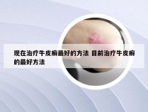 现在治疗牛皮癣最好的方法 目前治疗牛皮癣的最好方法