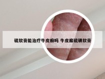硫软膏能治疗牛皮癣吗 牛皮廨硫磺软膏