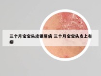 三个月宝宝头皮银屑病 三个月宝宝头皮上有癣
