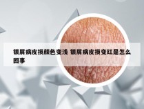 银屑病皮损颜色变浅 银屑病皮损变红是怎么回事