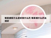 银屑病有什么症状用什么药 银屑病什么药治得好