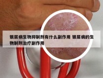 银屑病生物抑制剂有什么副作用 银屑病的生物制剂治疗副作用