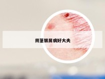 阴茎银屑病好大夫
