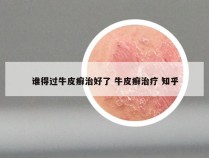 谁得过牛皮癣治好了 牛皮癣治疗 知乎