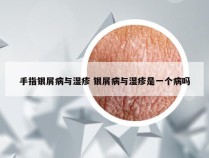 手指银屑病与湿疹 银屑病与湿疹是一个病吗