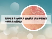 贵阳哪里有治疗银屑病的费用 贵阳哪里有治疗银屑病的费用高