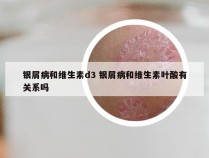 银屑病和维生素d3 银屑病和维生素叶酸有关系吗