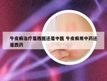 牛皮癣治疗是西医还是中医 牛皮癣用中药还是西药
