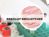 股癣是怎么治疗 股癣怎么治疗可以除根
