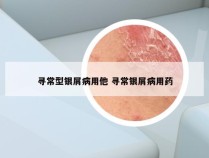 寻常型银屑病用他 寻常银屑病用药