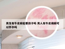 男生有牛皮癣能要孩子吗 男人有牛皮病癣可以怀孕吗