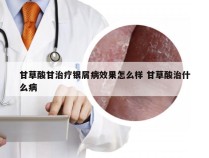 甘草酸甘治疗银屑病效果怎么样 甘草酸治什么病