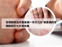 生物制剂治疗银屑病一年打几针 银屑病的生物制剂打几针有效果