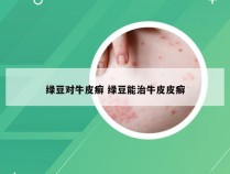 绿豆对牛皮癣 绿豆能治牛皮皮癣