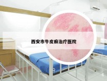 西安市牛皮癣治疗医院