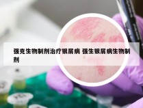 强克生物制剂治疗银屑病 强生银屑病生物制剂